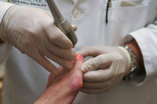 Laser treatment for toe rejuvination