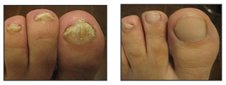 Fungal Nail Disease cured at the Wilson Foot Clinic